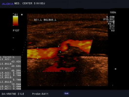 Ultrazvok vratnih žil - kalciniran plak v karotidi